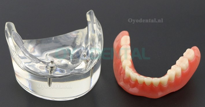 Tandentandenmodel Overdenture Inferieur met 2 implantaten Studiedemo Model 6002 01